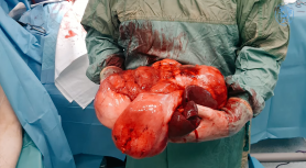 Chirurgii de la SCR au înlăturat o tumoare de 15 kg la un bărbat de 54 de ani